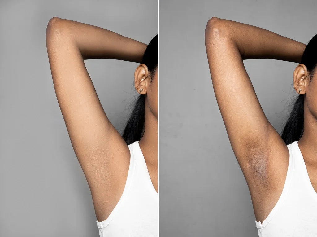 Dark underarms: Causes, treatment, and prevention