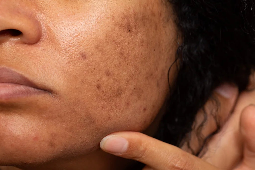 Dark spots from Acne