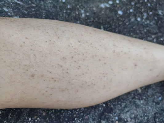  Keratosis Pilaris