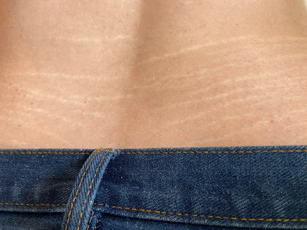 Stretch Marks 