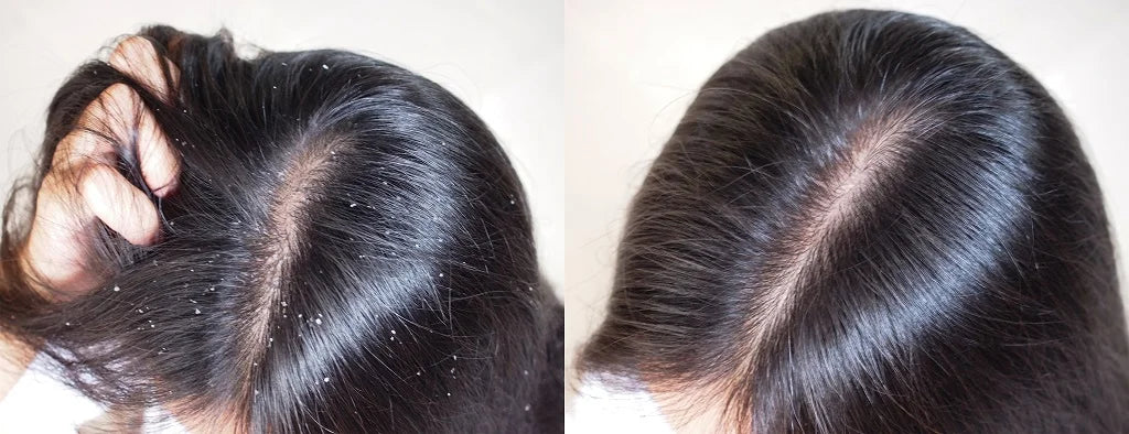 Dandruff Vs Dry Scalp