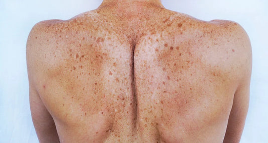 Post -Inflammatory Hyperpigmentation