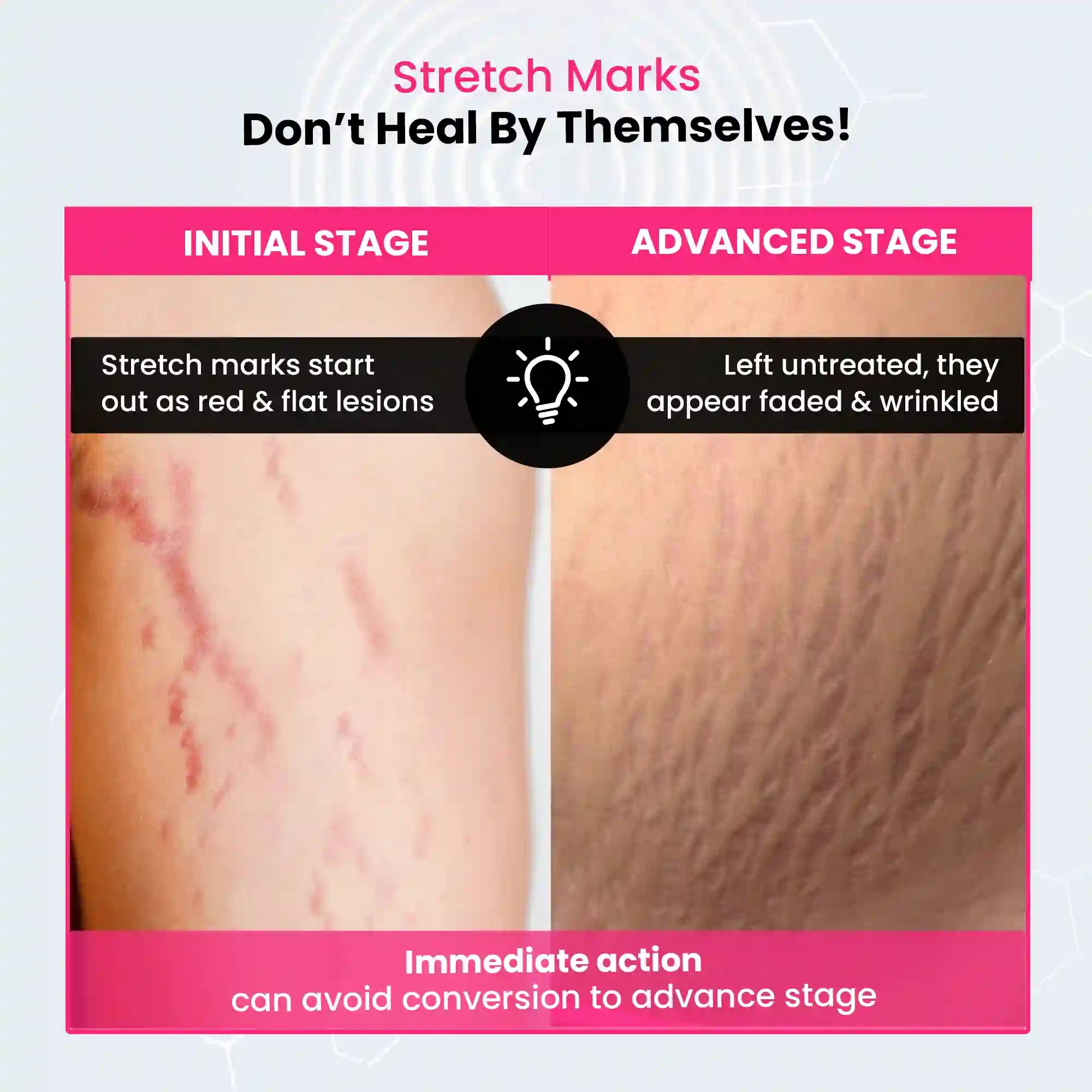 Best Stretch Marks Serum Cream for Women, See Visible Results in 28 Days