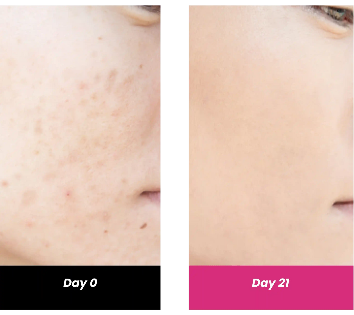 results after using niacinamide face serum for 21 days