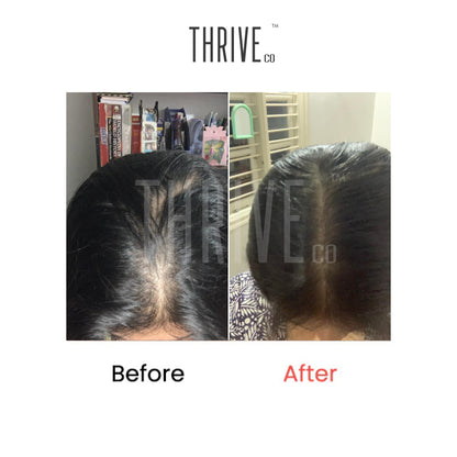 Hair Care Kit: ThriveCo Scalp Scrub (100ml) + Vitalizing Serum (50ml) + Hair Growth Serum (50ml)