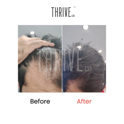 Hair Care Kit: ThriveCo Scalp Scrub (100ml) + Vitalizing Serum (50ml) + Hair Growth Serum (50ml)