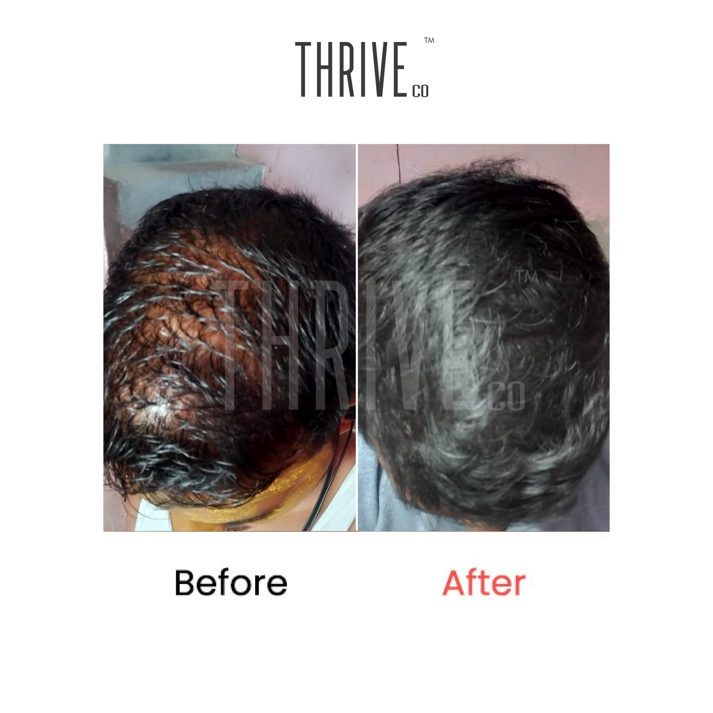 Hair Care Kit: ThriveCo Scalp Scrub (100ml) + Vitalizing Serum (50ml) + Hair Growth Serum (50ml)