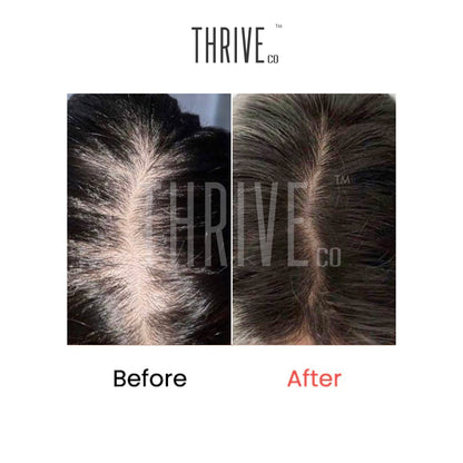 Hair Care Kit: ThriveCo Scalp Scrub (100ml) + Vitalizing Serum (50ml) + Hair Growth Serum (50ml)